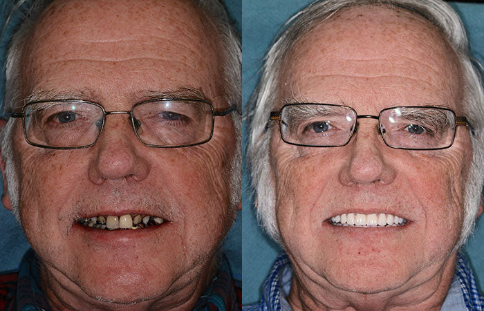 𝐇𝐢𝐝𝐨𝐧𝐞® --🦷Advanced Customized Full Denture Set🦷 (⏰Limited time discount last 30 minutes⏰)🍁💖