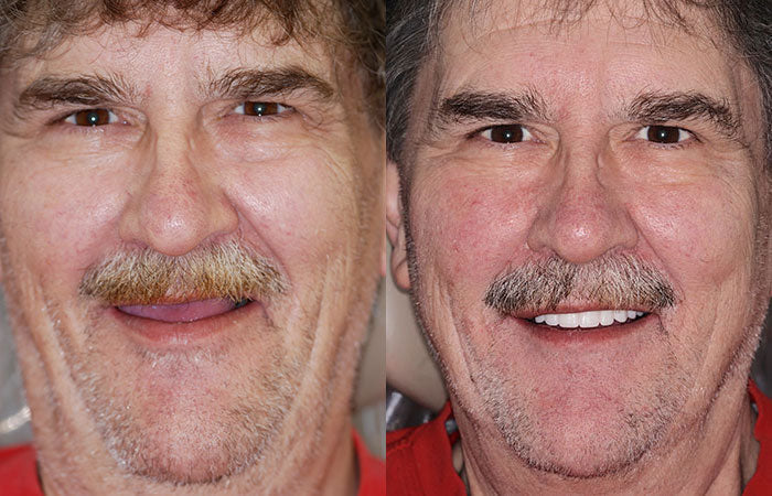 𝐇𝐢𝐝𝐨𝐧𝐞® --🦷Advanced Customized Full Denture Set🦷 (⏰Limited time discount last 30 minutes⏰)🍁💖