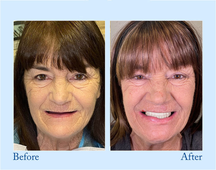 𝐇𝐢𝐝𝐨𝐧𝐞® --🦷Advanced Customized Full Denture Set🦷 (⏰Limited time discount last 30 minutes⏰)🍁💖