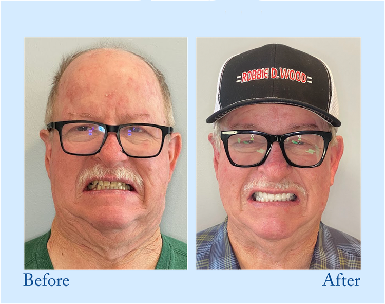 𝐇𝐢𝐝𝐨𝐧𝐞® --🦷Advanced Customized Full Denture Set🦷 (⏰Limited time discount last 30 minutes⏰)🍁💖