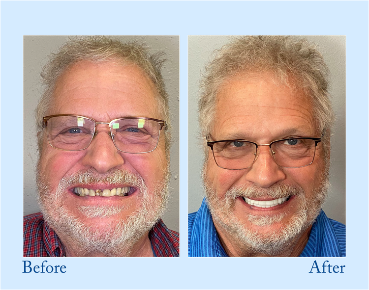 𝐇𝐢𝐝𝐨𝐧𝐞® --🦷Advanced Customized Full Denture Set🦷 (⏰Limited time discount last 30 minutes⏰)🍁💖