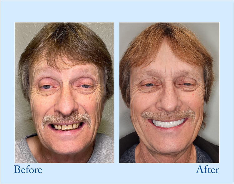 𝐇𝐢𝐝𝐨𝐧𝐞® --🦷Advanced Customized Full Denture Set🦷 (⏰Limited time discount last 30 minutes⏰)🍁💖