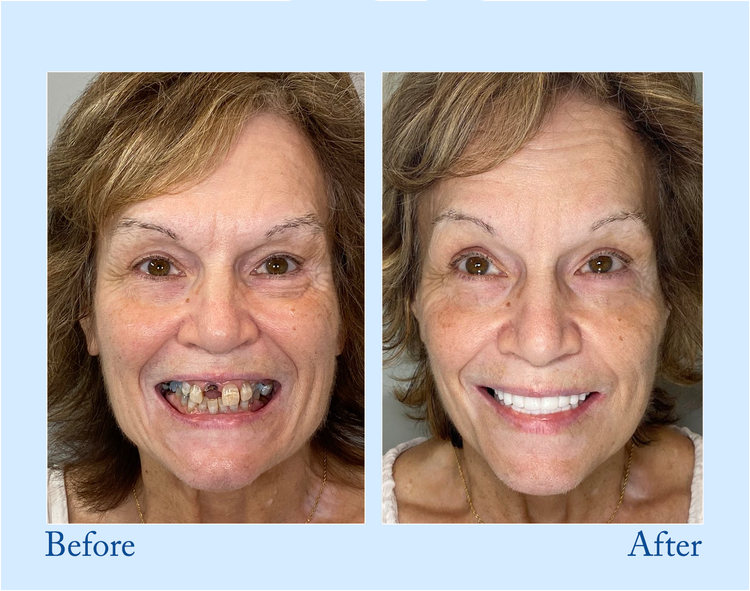 𝐇𝐢𝐝𝐨𝐧𝐞® --🦷Advanced Customized Full Denture Set🦷 (⏰Limited time discount last 30 minutes⏰)🍁💖