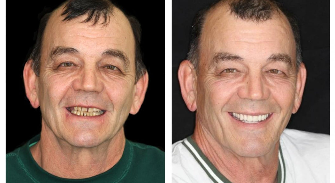 𝐇𝐢𝐝𝐨𝐧𝐞® --🦷Advanced Customized Full Denture Set🦷 (⏰Limited time discount last 30 minutes⏰)🍁💖