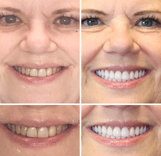 𝐇𝐢𝐝𝐨𝐧𝐞® --🦷Advanced Customized Full Denture Set🦷 (⏰Limited time discount last 30 minutes⏰)🍁💖