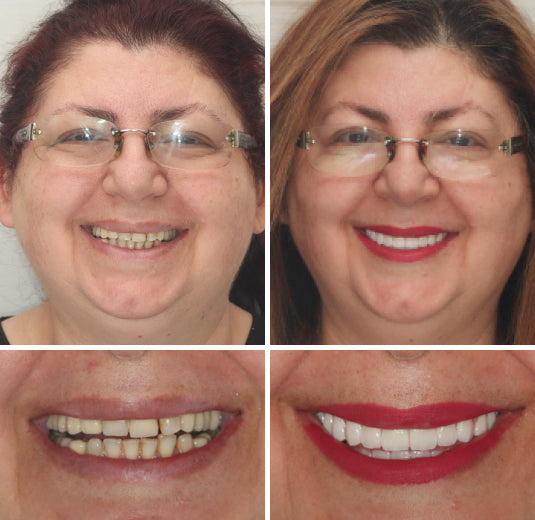 𝐇𝐢𝐝𝐨𝐧𝐞® --🦷Advanced Customized Full Denture Set🦷 (⏰Limited time discount last 30 minutes⏰)🍁💖