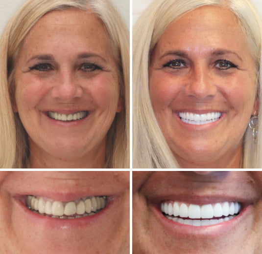 𝐇𝐢𝐝𝐨𝐧𝐞® --🦷Advanced Customized Full Denture Set🦷 (⏰Limited time discount last 30 minutes⏰)🍁💖