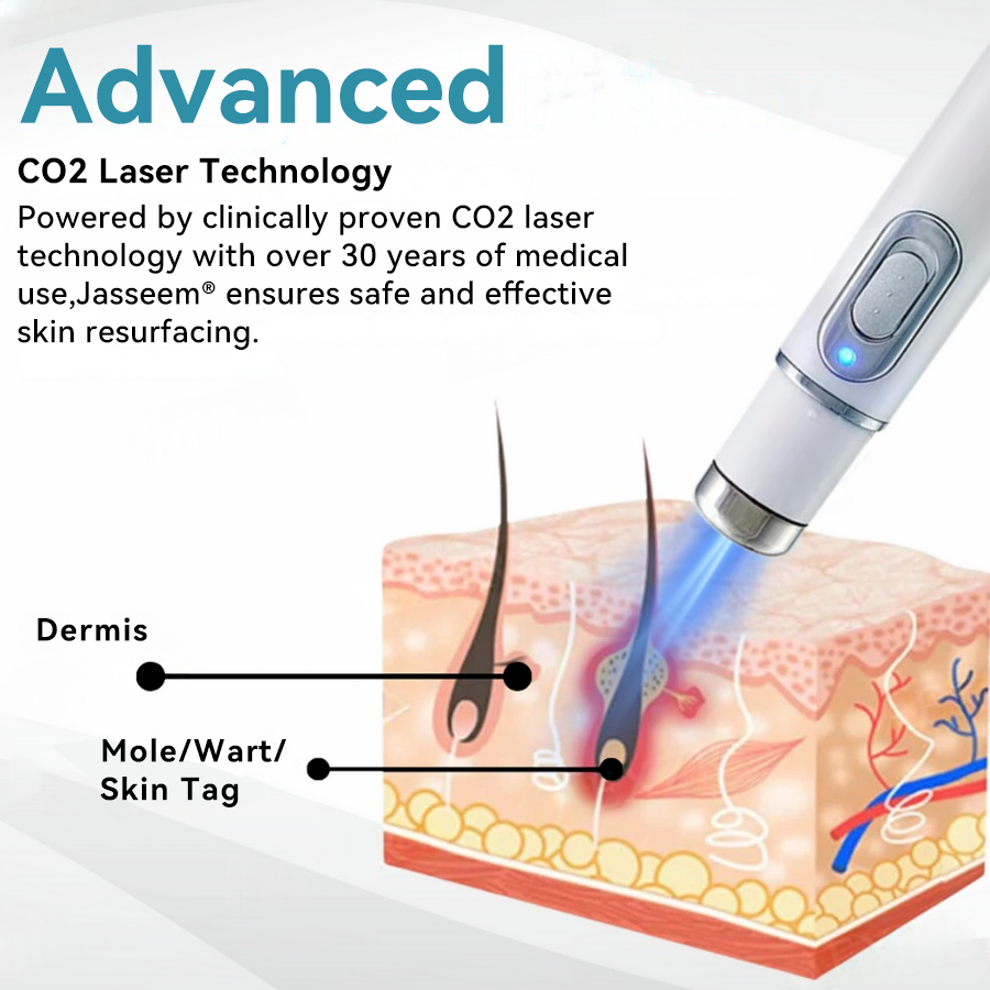 [Visible results in just 7 days]💧𝐉𝐚𝐬𝐬𝐞𝐞𝐦® Non-invasive Mole and Wart Removal Laser Pen (Quick and painless removal of warts, moles, age spots and skin tags - without any side effects)🫐