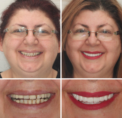 𝐇𝐢𝐝𝐨𝐧𝐞® --🦷Advanced Customized Full Denture Set🦷 (⏰Limited time discount last 30 minutes⏰)🍁💖