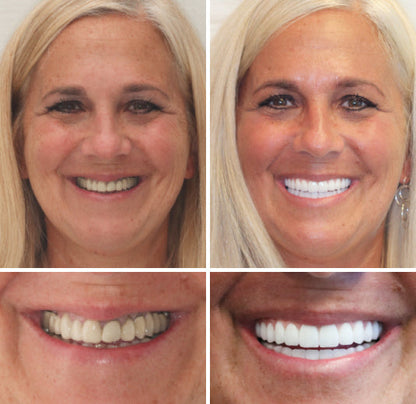 𝐁𝐢𝐤𝐞𝐧𝐝𝐚® --🦷Advanced Customized Full Denture Set🦷 (⏰Limited time discount last 30 minutes⏰)🍁💖